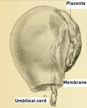  Exemple de sac amniotique après l'accouchement.