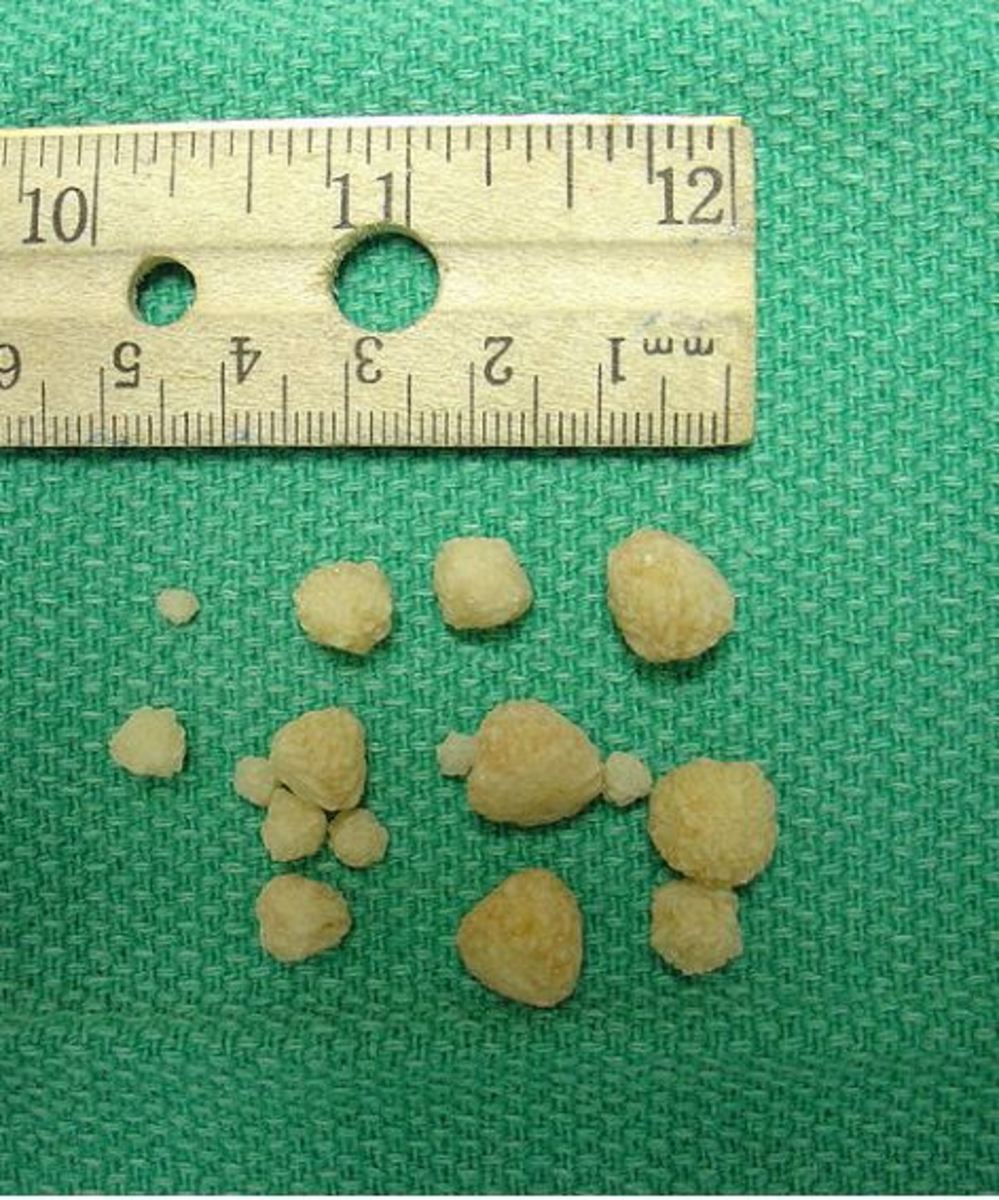 calcium oxalate stones in dogs picture