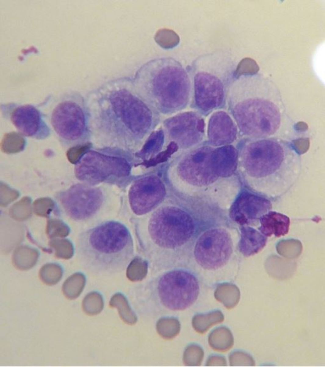  Cytology from a needle aspiration biopsy of a canine transmissible venereal tumor.