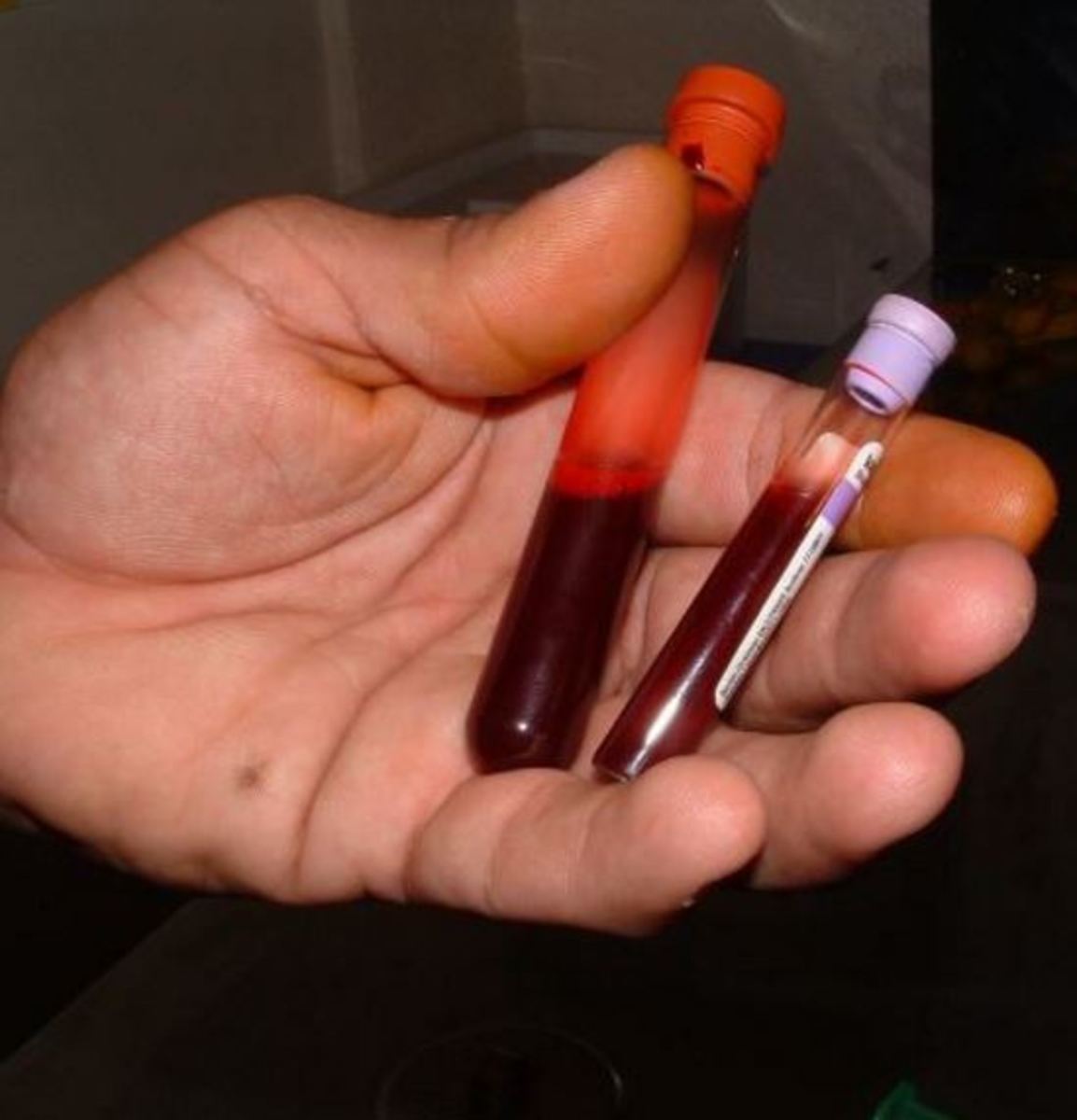  The results of the blood test showed very low level of thrombocytes.