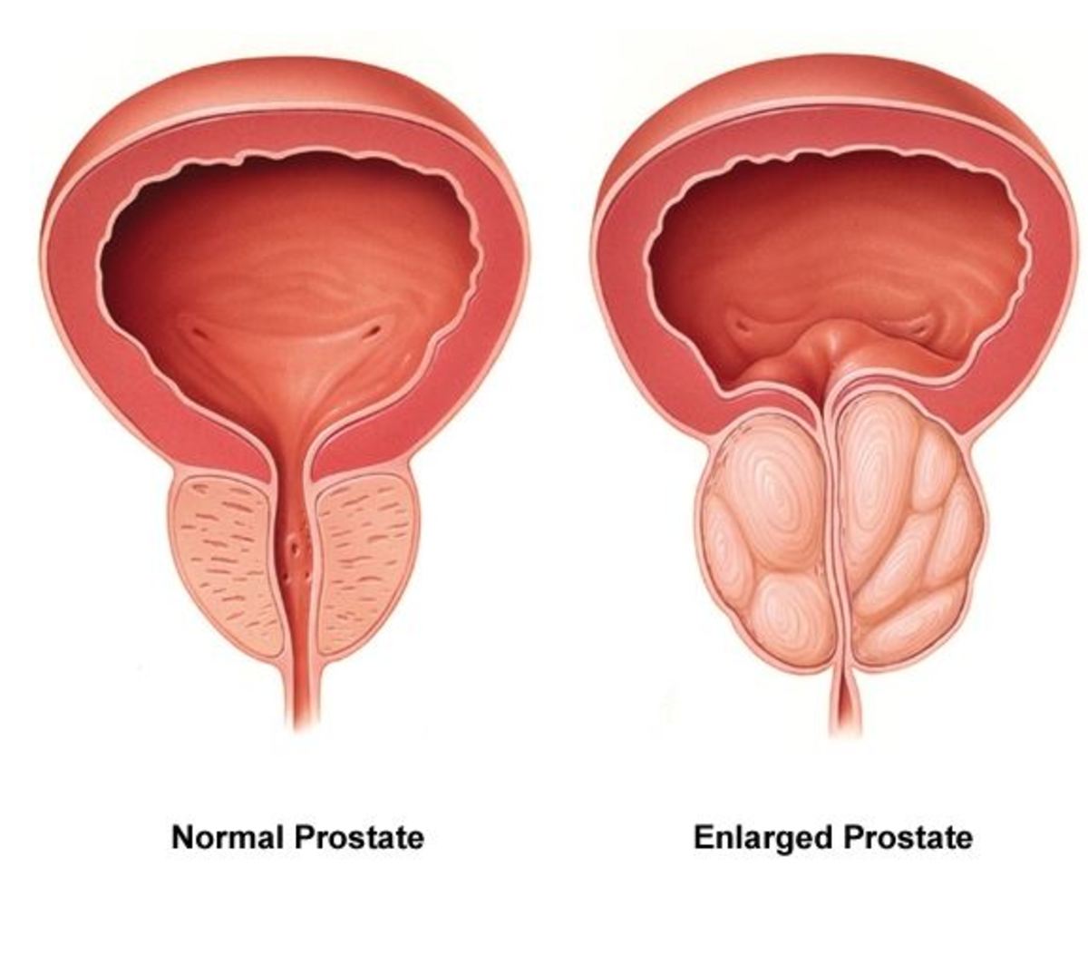 is prostate cancer in dogs treatable