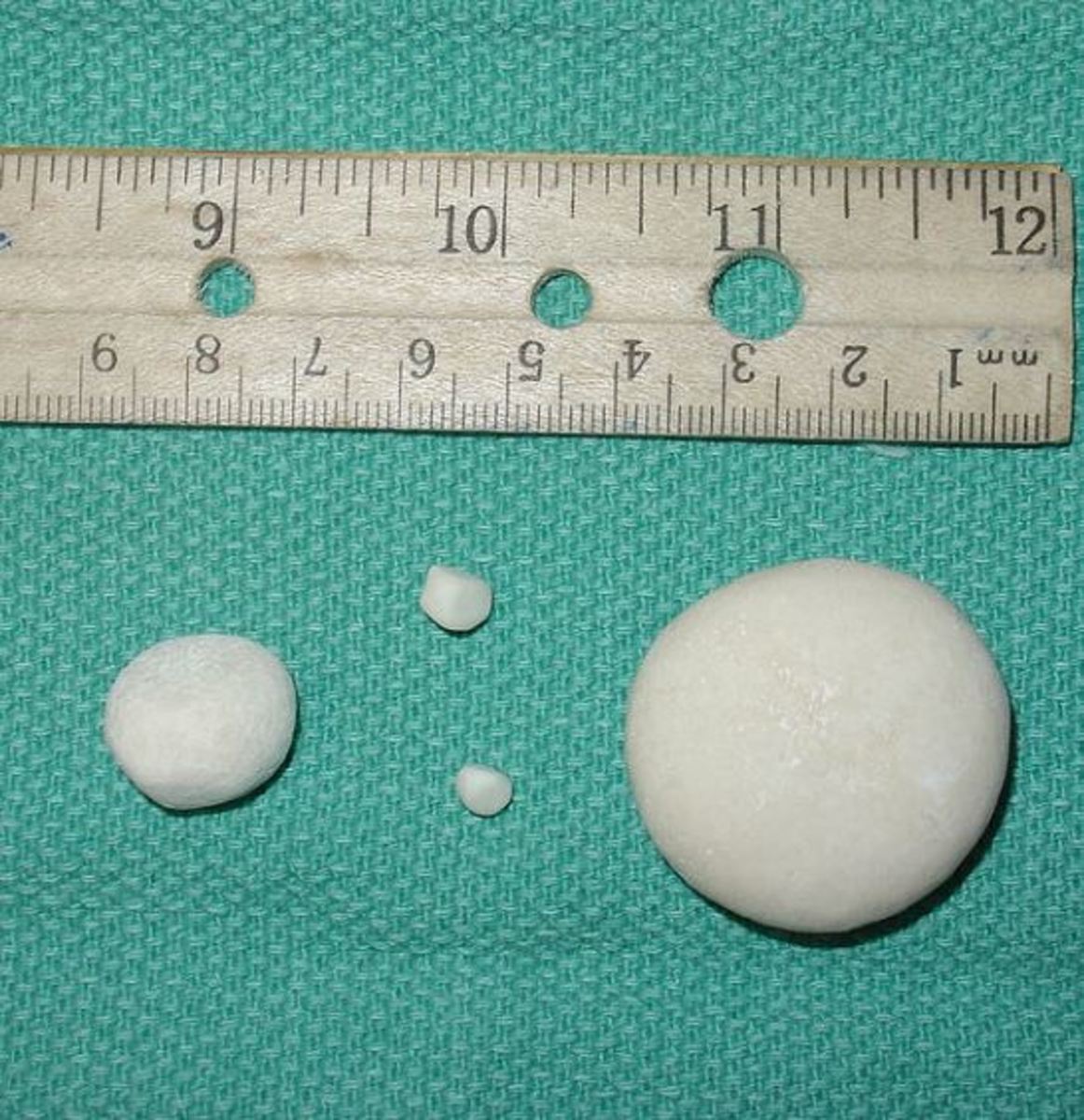  Picture of struvite stones in dog.